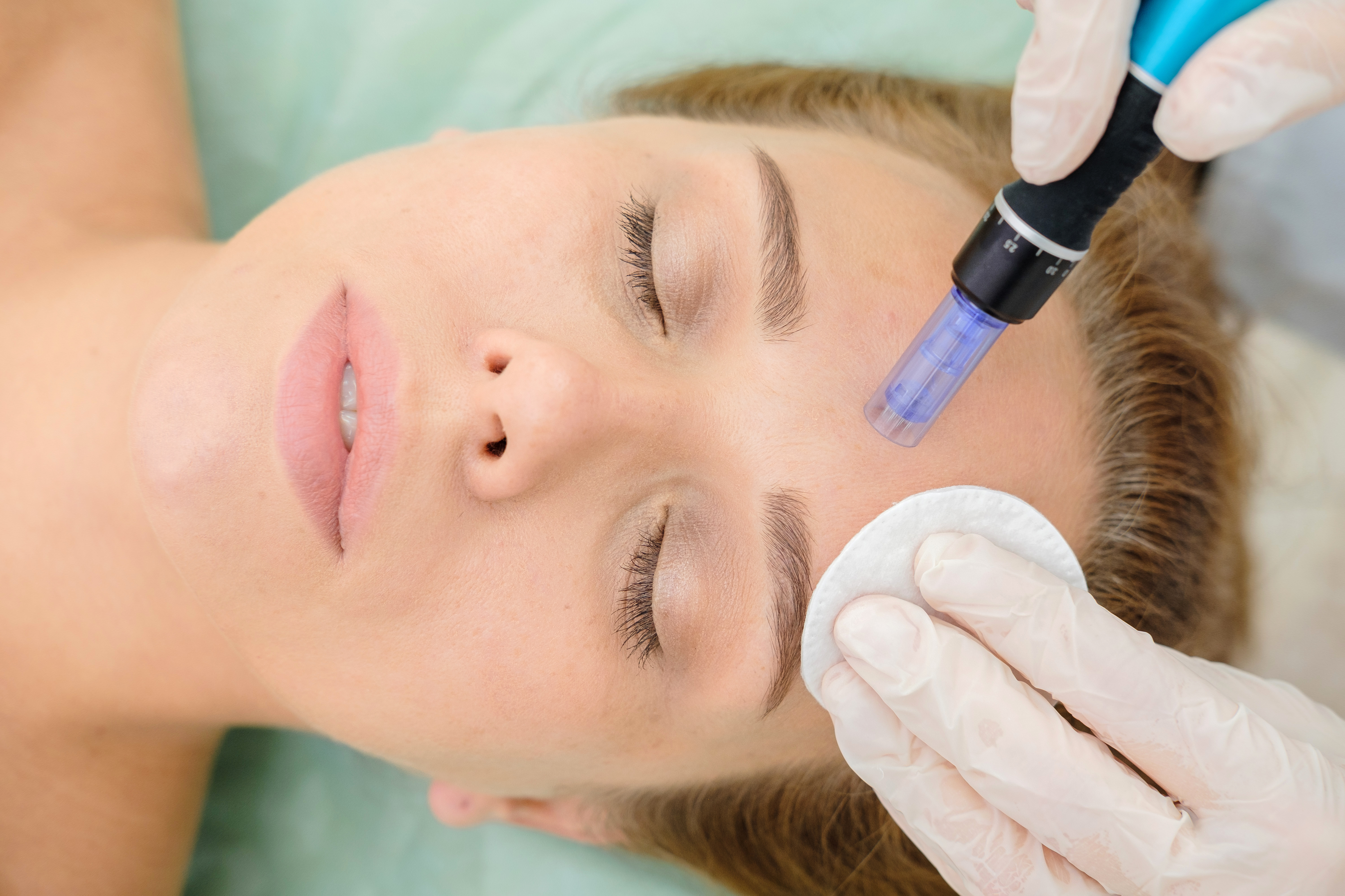 Microneedling & Skin Rejuvenation 1 1782250839 fefefa24a85c49f399c3675cf0adf2d6 1