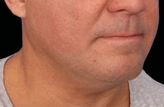 After Image: Emface - right-front-oblique