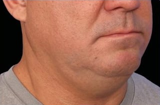 Before Image: Emface - right-front-oblique