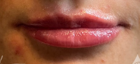 After Image: Lip Filler - front