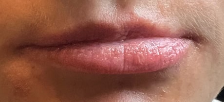 Before Image: Lip Filler - front