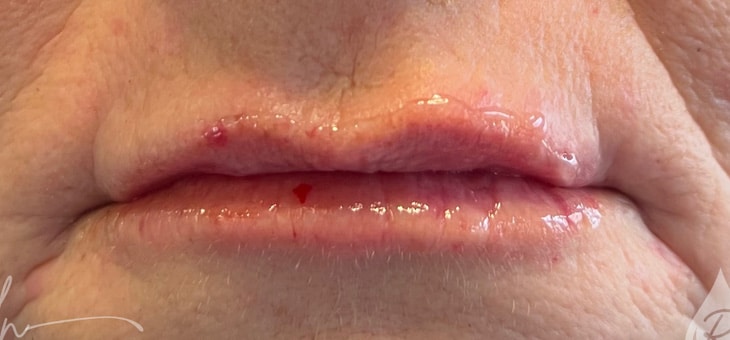 After Image: Lip Filler - front