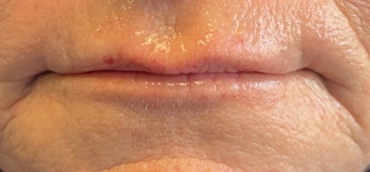 Before Image: Lip Filler - front