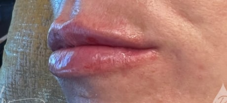 After Image: Lip Filler - left-front-oblique