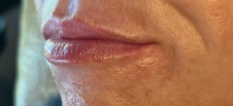 Before Image: Lip Filler - left-front-oblique