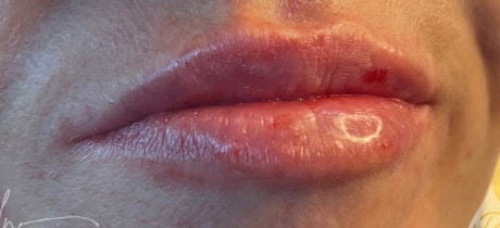 After Image: Lip Filler - front