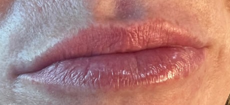 Before Image: Lip Filler - front