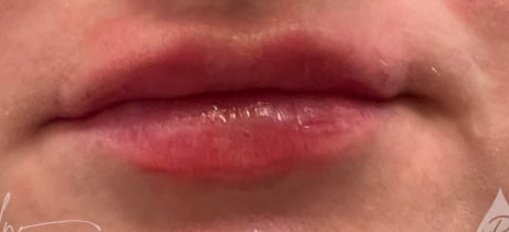 After Image: Lip Filler - front