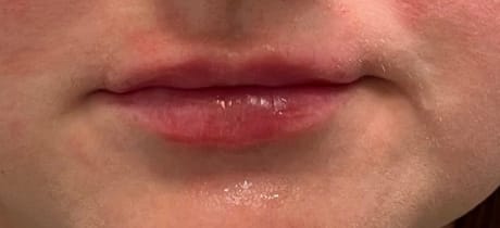 Before Image: Lip Filler - front