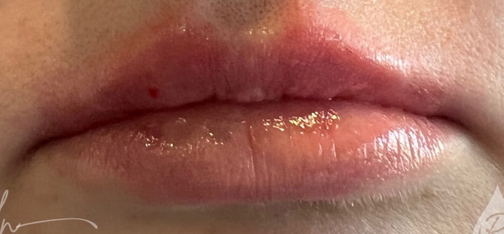 After Image: Lip Filler - front