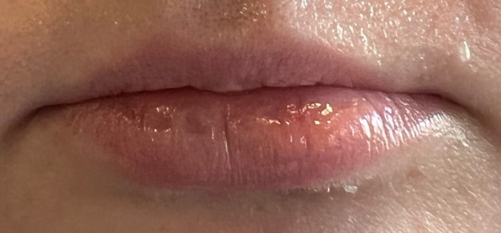 Before Image: Lip Filler - front