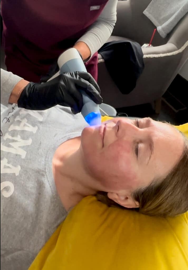 EXION RF Microneedling 1 IMG 1892
