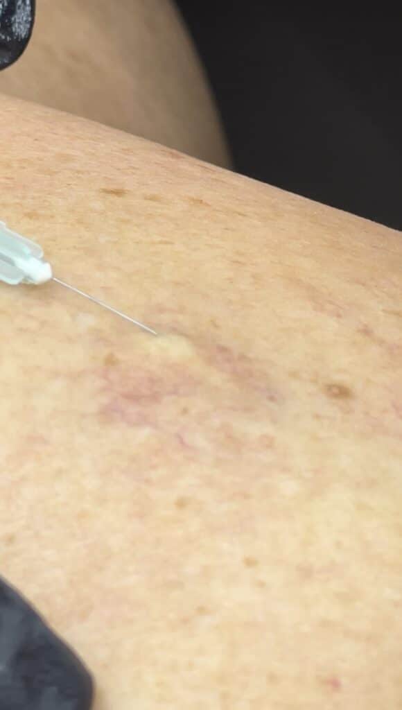 Sclerotherapy 1 IMG 3966